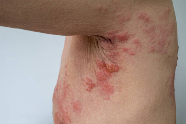 Shedding Light on The Disease: Can Teenagers Get Shingles?