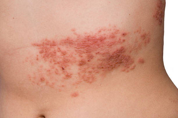 Decoding About The Disease: What does shingles look like?